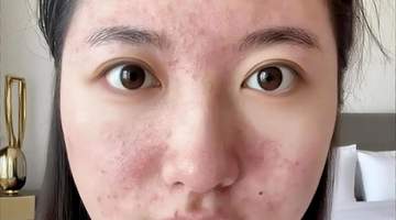 原创15岁女儿看皮肤却被开避孕药,妈妈怒气冲冲问为什么?医生的一番解释让妈妈羞惭不已,连连道谢