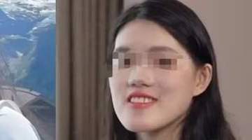 武汉女孩正颌手术遭反向操作 多地专家会诊指需七次修复