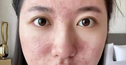 原创15岁女儿看皮肤却被开避孕药,妈妈怒气冲冲问为什么?医生的一番解释让妈妈羞惭不已,连连道谢