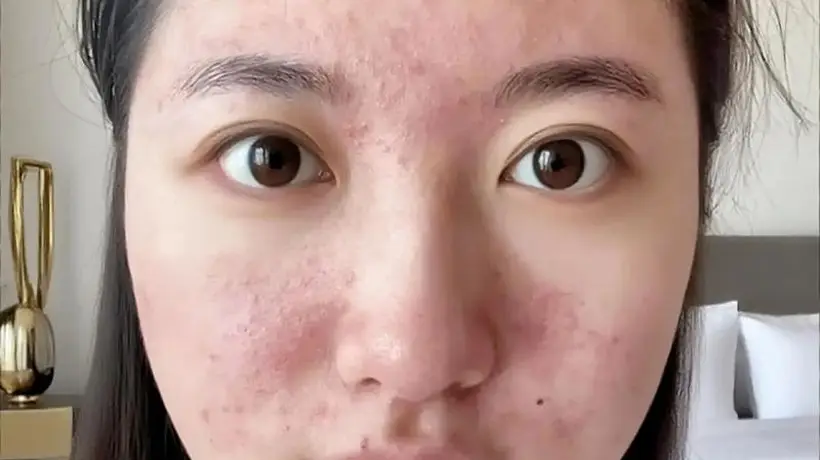 原创15岁女儿看皮肤却被开避孕药,妈妈怒气冲冲问为什么?医生的一番解释让妈妈羞惭不已,连连道谢