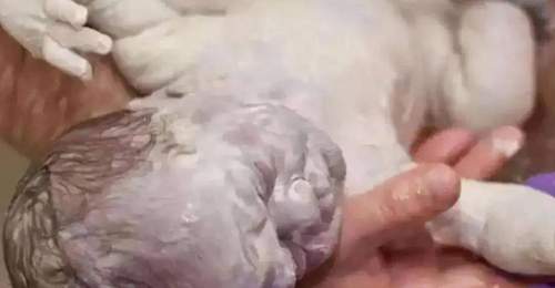 90后宝妈诞下“雪人宝宝”,宝爸吓得不敢抱娃,医生:恭喜了