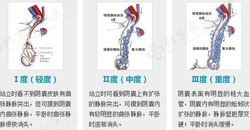 备孕两年无果,28岁杭州男子傻眼:这里竟藏了一窝“蚯蚓”!医生:千万别小看了