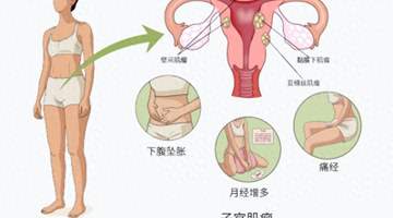 杭州一女子常被误认怀孕,腹中竟藏着50颗子宫肌瘤