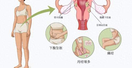 杭州一女子常被误认怀孕,腹中竟藏着50颗子宫肌瘤