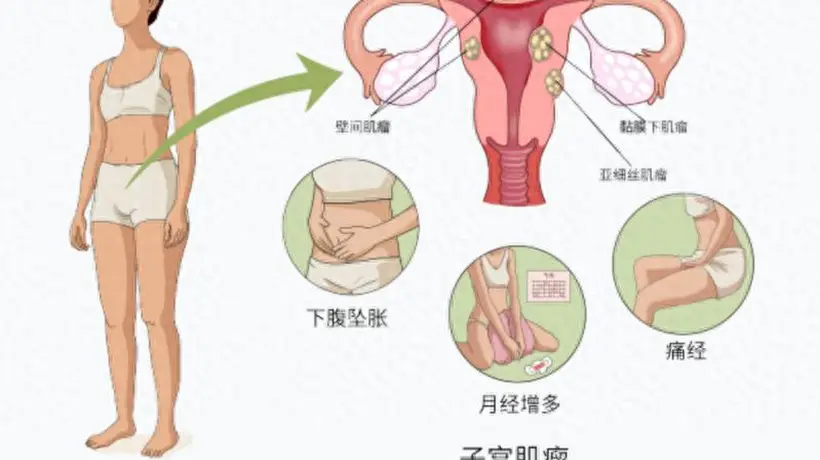 杭州一女子常被误认怀孕,腹中竟藏着50颗子宫肌瘤